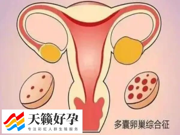 多囊导致排卵障碍不孕，这3大症状可判断(图1)