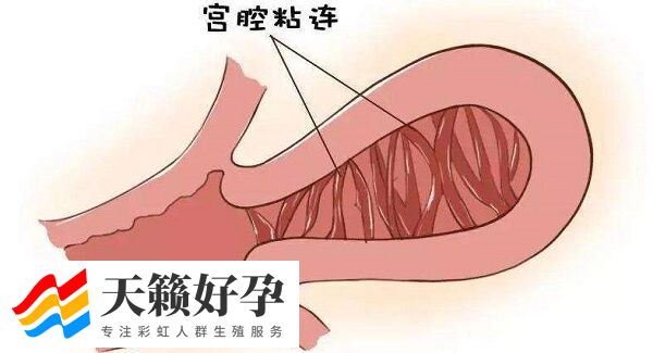 引发宫腔粘连的因素是什么(图2)